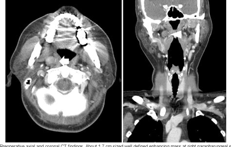 Figure 2 From A Case Of Chronic Tonsillitis Mimicking A Parapharyngeal