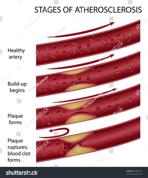 Stages Of Atherosclerosis Stock Vector Illustration 79593727 : Shutterstock