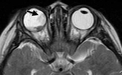 High Resolution Mr Imaging Of The Orbit In Patients With Retinoblastoma