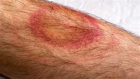 Lyme Disease Symptoms Bulls Eye Rash Isnt Whole Story Cbs News