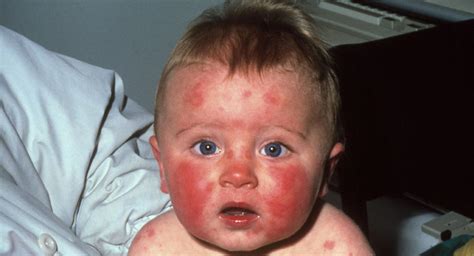 Slapped Cheek Syndrome Fifth Disease In Babies And Toddlers