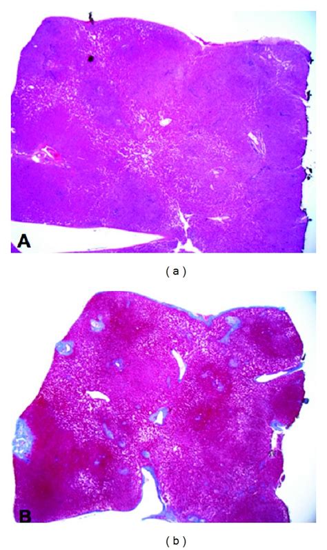 Liver Wedge Resection A This Is A Wedge Resection Specimen