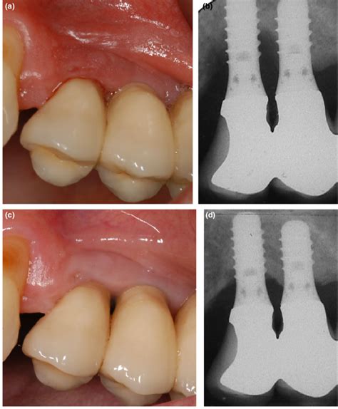 Baseline View Of Implants 24 And 25 With Ppd ≤8 Mm Bleeding On Probing