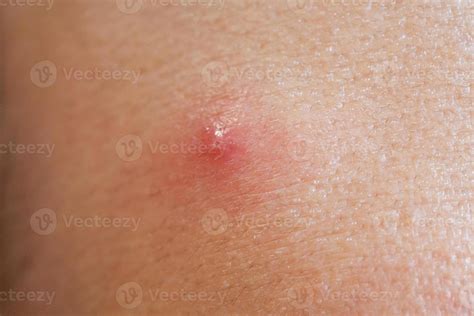 Inflammatory Acne With Red Spot On Face Closeup 12810177 Stock Photo At