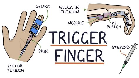 Understanding Trigger Finger Stenosing Tenosynovitis Youtube