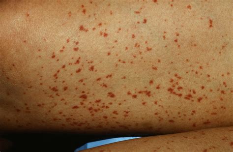 Wayne Chapman Rumor Tiny Red Dots On Skin