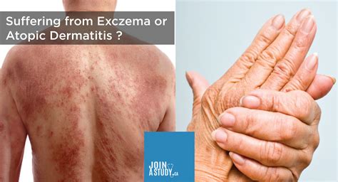 Experiencing From Eczema Or Atopic Dermatitis JoinAStudy Ca