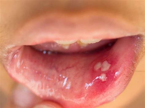 Human papillomavirus (hpv) is the most common sexually transmitted infection in the united states. Infecção pelo Papilomavírus Humano (HPV) em homens - Fatos M.