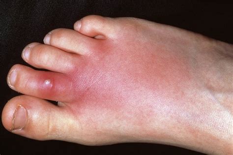 Foot Rash Symptoms Causes And Treatments You Need To Know Speedy