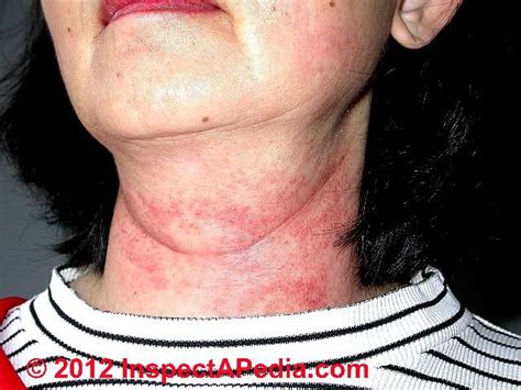Fungi love dark, moist areas. Neck rash from mold exposure (C) D Friedman | Mold ...