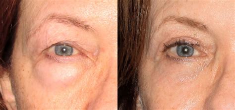 The cost of treatment can vary anywhere between rs 40000 to rs 100000 depending upon various eye surgery to be done for correction of severe refractive errors. Blepharoplasty - Phoenix, AZ - Sun City West, AZ - Sun City, AZ