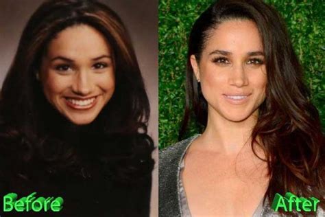 Meghan Markle Nose Job Rhinoplasty Before And After Photos