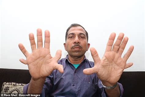 The Man With The Most Fingers And Toes In The World Express Digest