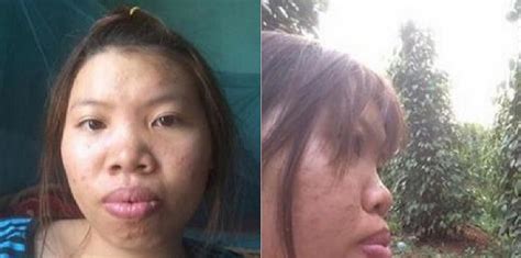 Bullied Vietnamese Girl Regains Self Confidence With 14000 Of Plastic
