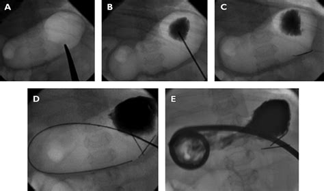 Long Term Results Of Percutaneous Radiologic Gastrostomy And