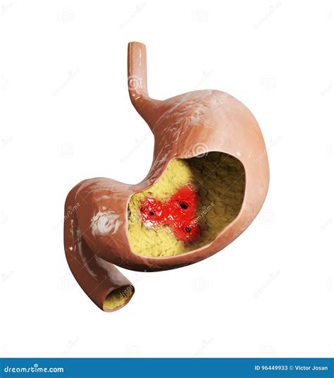 Illustrazione D Dell Ulcera Allo Stomaco Anatomia Umana Dello Stomaco