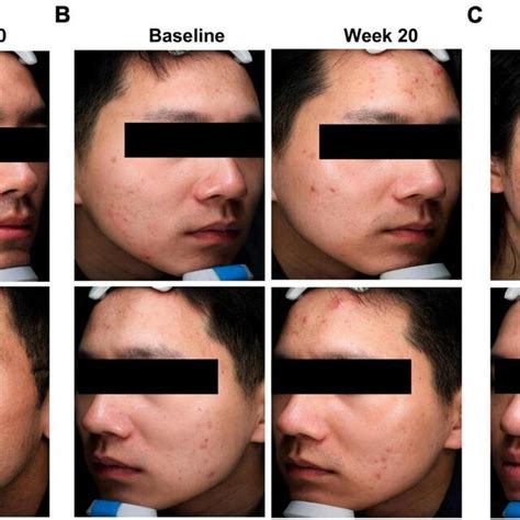 Clinical Photographs Revealed The Improvement Of Acne Scars By Both
