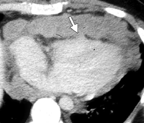 Primary Pericardial Lymphoma Contrast Enhanced Ct Image Of The Chest