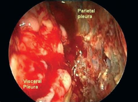Check spelling or type a new query. Medical thoracoscopy showing advanced-stage malignant ...