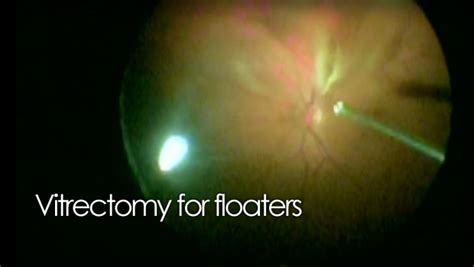 Pars Plana Vitrectomy For Floaters Video
