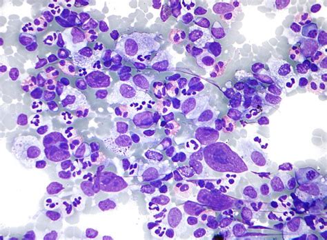 Hodgkin Lymphoma Libre Pathology