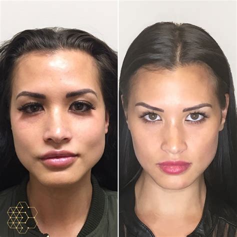 Facial Slimming Vancouver Bc Non Surgical Jawline Treatment