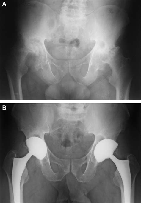 Anteroposterior Pelvic Radiograph Rapidly Destructive Hip Disease A