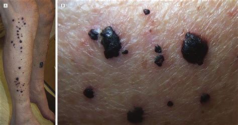 Remote Hemorrhagic Bullae Occurring In A Patient Treated With