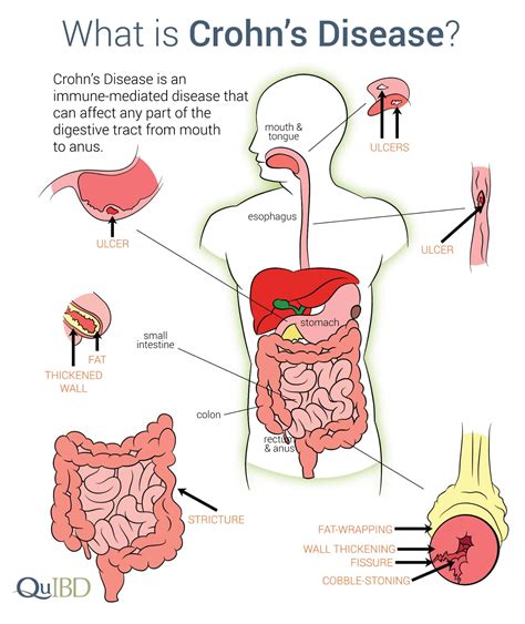 Crohn’s Disease Sexuality In Chronic Illness Fa 20
