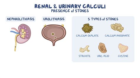 Renal And Urinary Calculi Nursing Osmosis Video Library