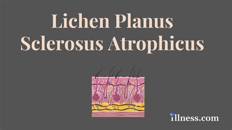 Lichen Planus Sclerosus Atrophicus Overview Causes Symptoms