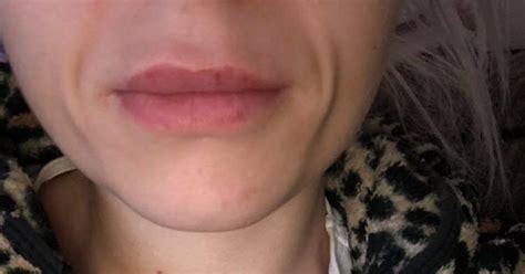 Lip Fillers Gone Wrong Bad Injections Before After