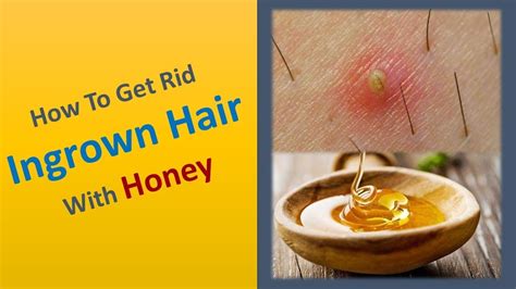 How To Get Rid Ingrown Hair With Honey Youtube