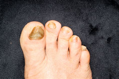 How Does Diabetes Affect Your Toenails And Feet