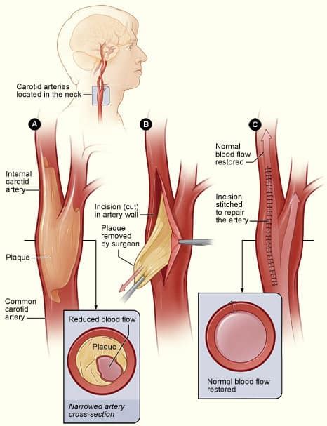Carotid Artery Disease Clinical Features Management TeachMeSurgery