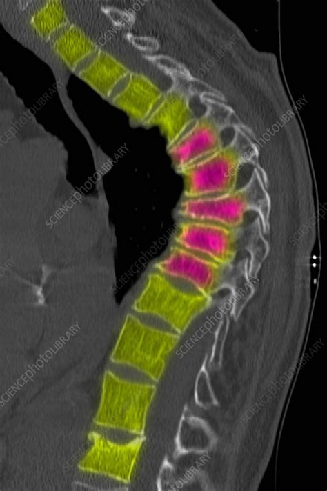 Ct Scan Of Thoracic Spine With Osteoporosis Stock Image F0188879