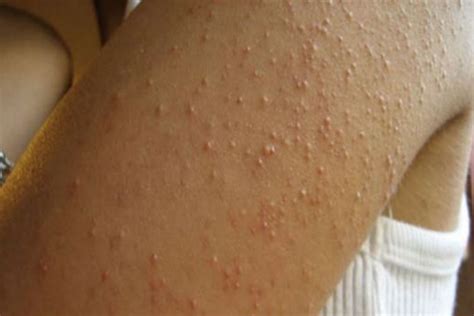 She Had Itchy Red Bumps All Over Her Skin But Was Shocked When She