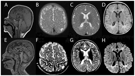 Brain MRI Demonstrated White Matter Abnormality Suggesting