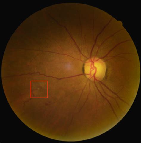 Retinal Imaging In Vitreous Hemorrhage Identification Collaborativeeye