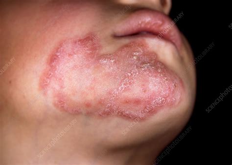 Tinea Fungal Face Infection Stock Image C0364844 Science Photo