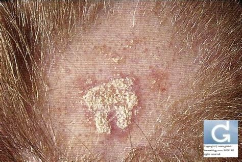 Inflammatory Skin Diseases Of The Scalp Globale Dermatologie
