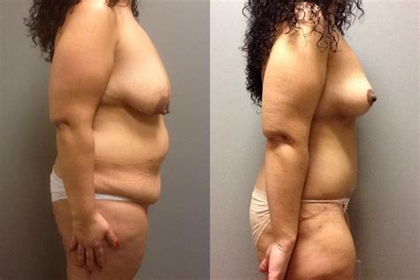 Abdominoplasty Before After Photos Patient Springfield Ma Aesthetic Plastic