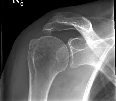 Radiology Cases Subacromial Spur