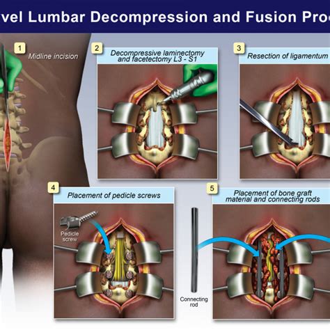 Multilevel Lumbar Decompression And Fusion Procedure Trialexhibits Inc