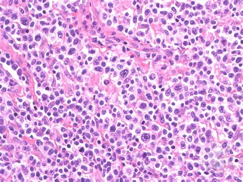 Peripheral T Cell Lymphoma Nos 2