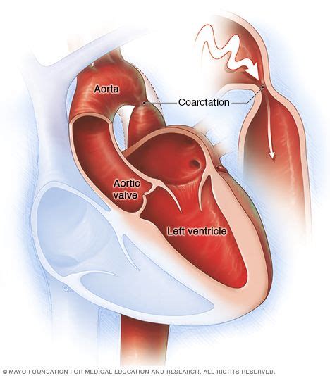 Coarctation Three Types Preductal Ductal And Coarctation Of The