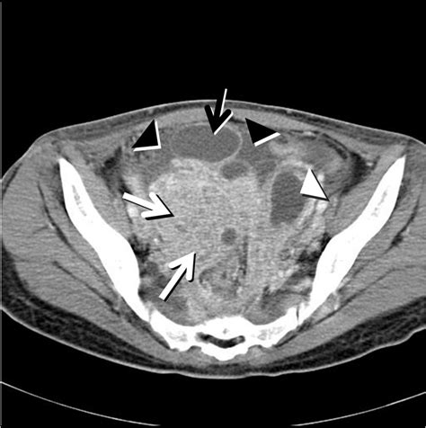A Contrast Enhanced Computed Tomography Ct Scan Shows Bilateral