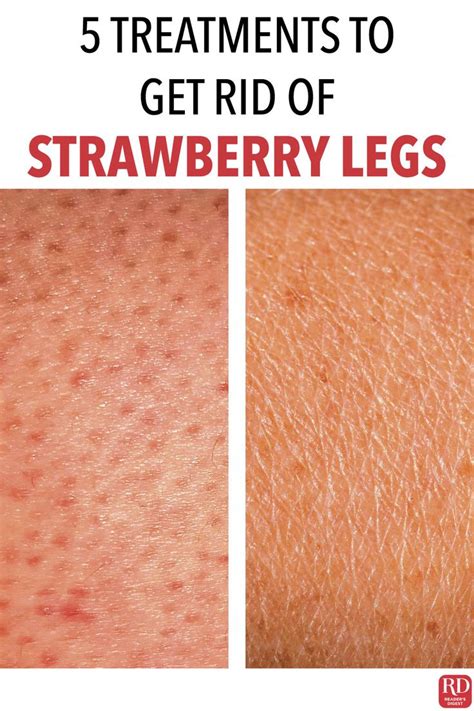 How To Get Rid Of Strawberry Legs 5 Treatments That Work Strawberry Legs Shaving Legs