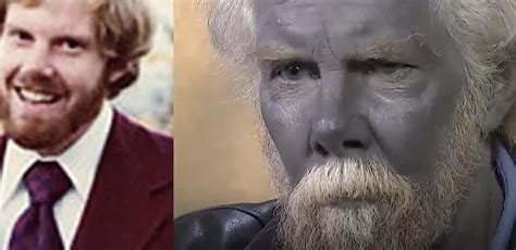 This Guy Drank Homemade Colloidal Silver For 20 Years And Turned Blue