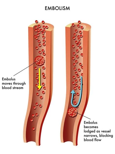 Cardiac Embolism Cause Symptoms Treatment Mobile Physio